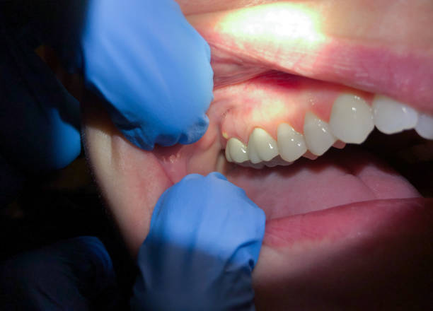 Best Emergency Gum Treatment in Citrus Springs, FL